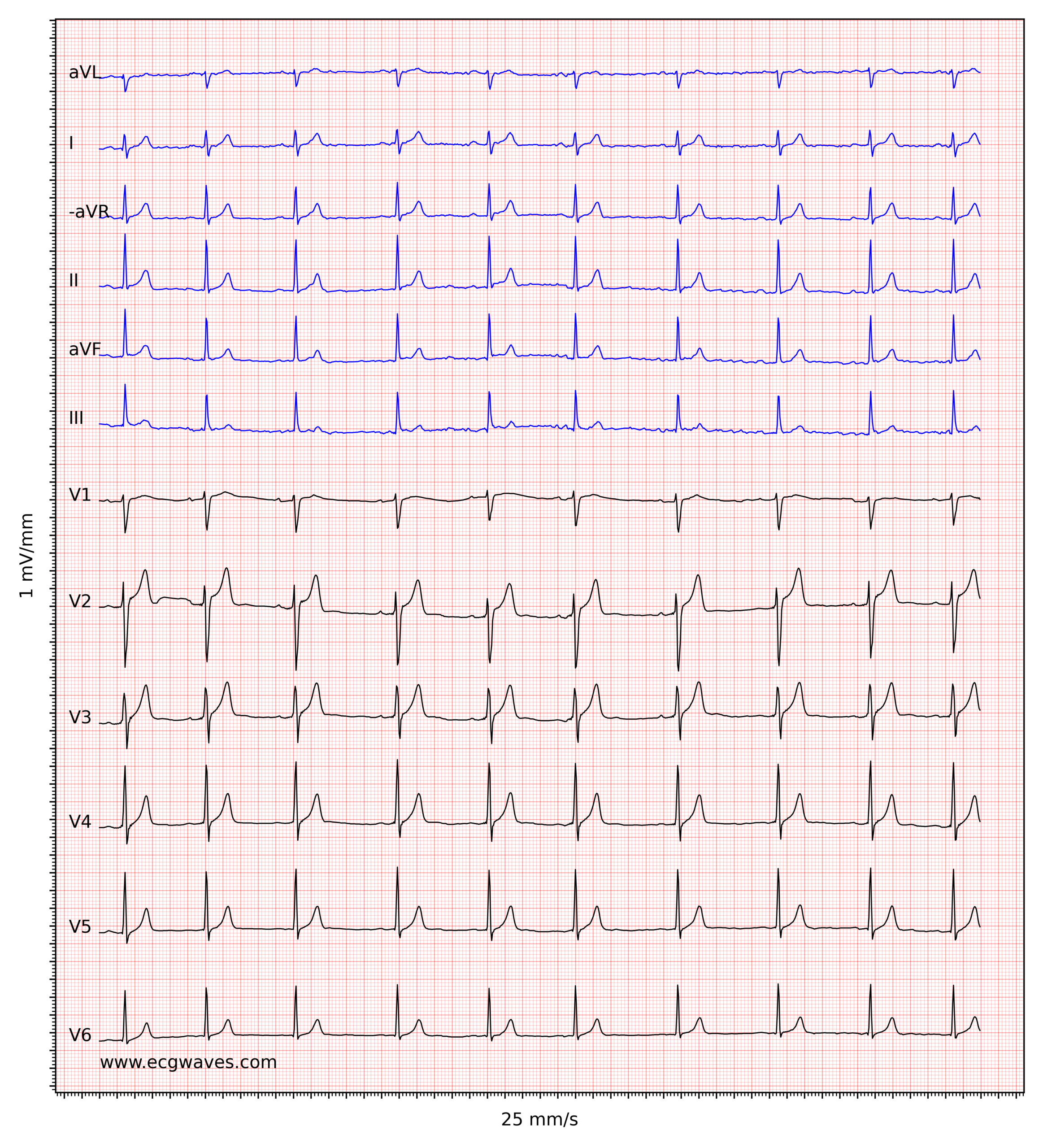 ECG Interpretation Characteristics Of The Normal ECG P wave QRS 