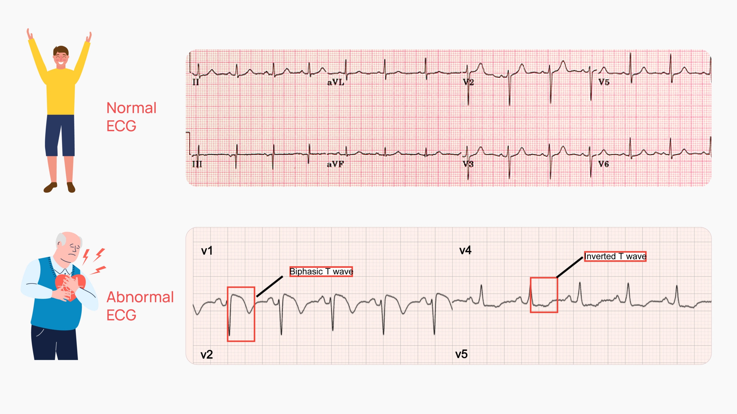 Ecg Graph Paper Explained
